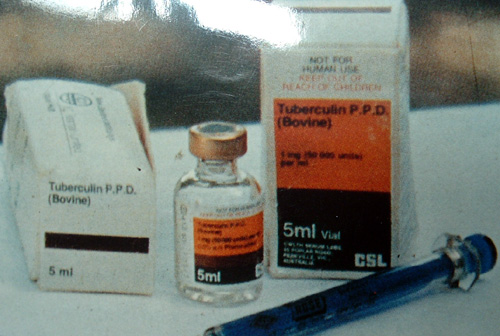 tuberculin